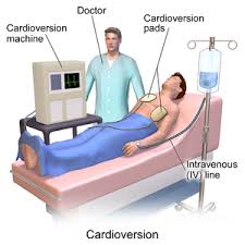 Image result for Synchronized Cardioversion