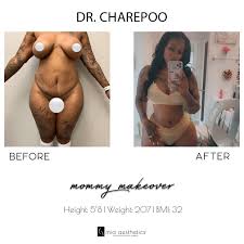 Surgery journey in miami with mia aesthetics. Mia Aesthetics On Twitter Amazing Transformation By Dr Charepoo Https T Co Bu2zqt5txe Twitter