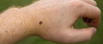 Most bites result in mild symptoms around the area of the bite. Identifying Spider Bites Symptoms Treatment Upmc Healthbeat