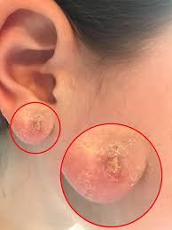 Maybe you would like to learn more about one of these? Mother S Outrage After Daughter S Ear Piercing Got Infected Daily Mail Online