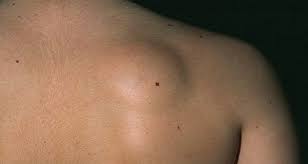 In these cases, the elbow lump may be related to swelling of the elbow. Harmless Tumor Leave It Or Lose It Health Stltoday Com