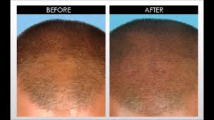 A healthy scalp is key to maintain healthy hair and preventing hair loss. Apple Cider Vinegar For Hair Loss Youtube Youtube