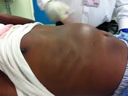 The data of the original study of patients with chronic hepatitis b and c, in whom we assessed the function of the biliary tract. Screen And Treat Scheme For Hepatitis B May Prevent Deadly Complications Imperial News Imperial College London