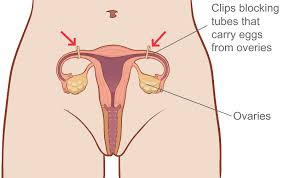 Tubal Ligation Tubes Tied Female Sterilisation Family Planning Victoria