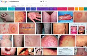 Image result for Erythema Multiforme Causes