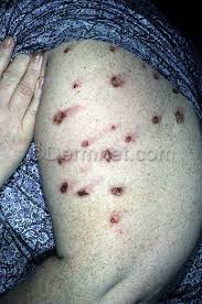 Image result for Neurotic Excoriation