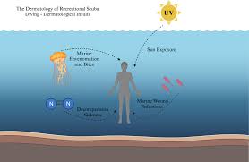 Image result for Decompression Sickness