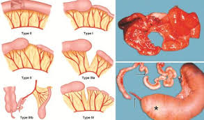 Image result for Intestinal Atresia