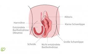 Jahrhunderts berichtet, dass sie über ungewöhnlich vergrößerte innere schamlippen verfügten, die deutlich sichtbar über die äußeren schamlippen hinausragten. Bartholinitis Ursachen Symptome Therapie Onmeda De