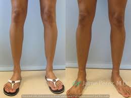 34 Year Old Female Fat Transfer To Calves Calf Augmentation Before And After Gallery