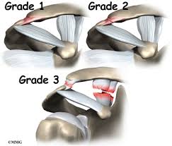A grade 2 ligament injury may require you to use crutches or a brace for several days. Acromioclavicular Joint Separation Orthogate