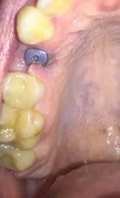 Image result for Alveolitis sicca)