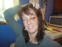 Mountain Biker's Recovery and Return to Cycling