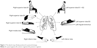 Full Text Management Of Airway Mucus Hypersecretion In