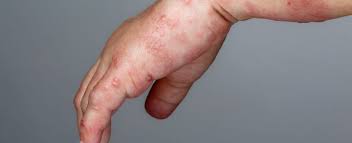 Image result for scabies on humans