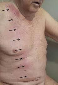 Early Ventriculoperitoneal Shunt Infection Springerlink