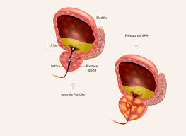 Explains prostate problems including prostatitis and benign prostatic hyperplasia. Prostata Symptome Und Therapie Urologie Berlin Mariendorf