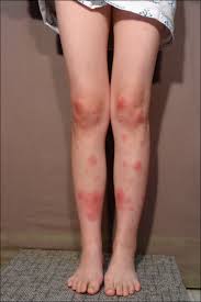Image result for erythema nodosum