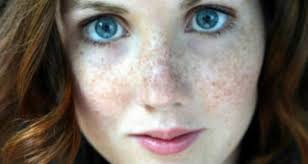 In fact, according to studies, having freckles are actually a sign of skin damage. 10 Effective Ways To Say Bye Bye To Freckles