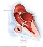Image result for what is the treatment for bicuspid aortic valve