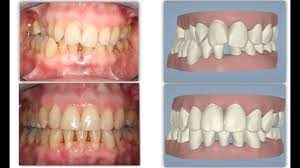 Everything start with a good planification. Amazing Invisalign Crossbite Orthodontic Treatment Incisor Extraction Without Braces Youtube