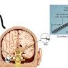 The implant can replace the function of the damaged ear and open up the world of sound. 1