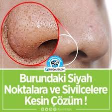 Burundaki Siyah Noktalara Ve Sivilcelere Kesin Cozum Guzellik Kadin Sivilce Siyahnokta Burun Akne Cilt Siyah Noktalar Dogal Akne Tedavisi Akne Tedavisi