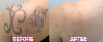 I have been doing research for a novel and have been speaking to a gentleman whose job is laser tattoo removal. Laser Tattoo Removal What You Should Be Looking For Restobod Com