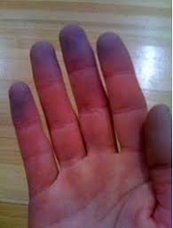 Cyanosis | Discoloration of the skin. — Steemit
