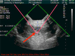 Radiation Pressure From Ultrasound Helps Kidney Stones Pass Summary Kidney stones, or renal calculi, are masses made of crystals. ultrasound helps kidney stones pass