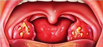 Gnojnaya Angina U Vzroslyh Simptomy Kak Vyglyadit Chto Znachit El Klinika
