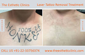The risk of tattoo removal is scarring, akhavan tells fox news. Tattoo Removal Mumbai Permanent Laser Tattoo Removal Treatment Cost India The Esthetic Clinics