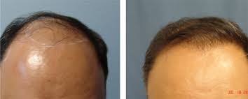 Hi, friends you find how much does laser hair removal cost in california then her cost 250$ to 380$ dollars per session. Hair Transplants Roseville Fut Transplant Sacramento
