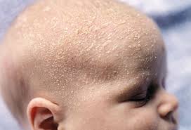 Eczema is sometimes called atopic dermatitis, which is the most common form. Eczema Tot Ce Trebuie Sa Stii