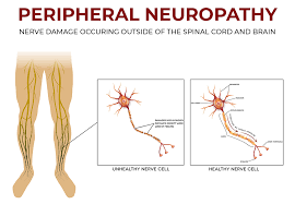 Help each other live better and uncover the best ways to manage your health today. How Does The Va Rate Diabetic Peripheral Neuropathy Hill Ponton P A