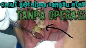Apakah gigi geraham bungsu dengan kondisi bengkak bisa dioperasi? Cabut Geraham Bungsu Atas Tanpa Operasi Youtube