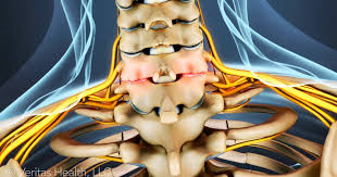 Cervical Facet Osteoarthritis Can Be Called Many Things Cervical Spondylosis Degenerative Joint Disease Or Simply Neck Arthritis But No Matter The Arthritis
