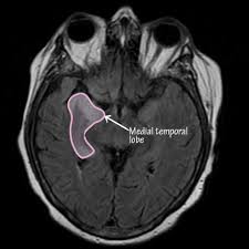 For viral infection of the meninges, please refer to the general article on viral meningitis, and, for a broad view on the curriculum of infections of the central nervous system, refer to cns. Hsv Encephalitis Herpes Simplex Encephalitis Type 1 Immunology Microbiology Flashcards Draw It To Know It