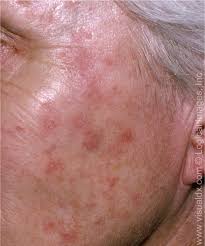 Melanoma — the least common form of skin cancer, but responsible for more deaths per year than squamous cell and basal cell skin cancers combined. Diagnosis And Treatment Of Basal Cell And Squamous Cell Carcinoma American Family Physician