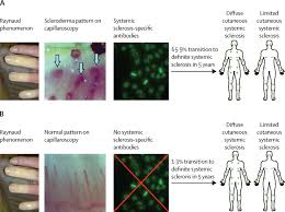 Image result for Systemic Sclerosis