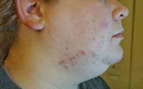 Hirsutism is the excessive growth of facial or body hair on women. Pcos And Your Skin Dermangelo