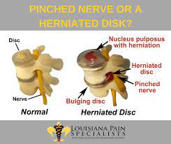 The endplates function to hold discs in place, evenly spread applied loads, and to provide anchorage for the collagen fibers of the. Is My Pain Caused By A Pinched Nerve Or A Herniated Disk Louisiana Pain Specialist