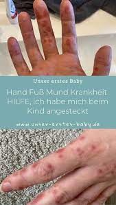 Hand Mund Fuss Bei Erwachsenen Ansteckend Und Schmerzhaft Hand Fuss Mund Krankheit Mund Hand Mund Fuss
