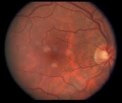 Pin On Ophthalmology