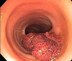 Sometimes it is called colon cancer, for short. Colon Polyps Which Ones Are Riskiest For You Health Essentials From Cleveland Clinic