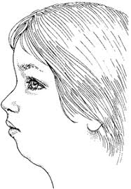 Image result for Micrognathia