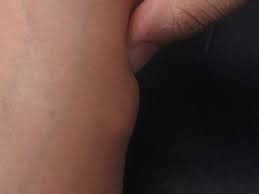 Lipome Comment Le Diagnostiquer Et Le Traiter Naturellement