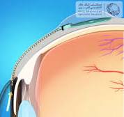 ‫زراعة الأنبوب لتخفيف ضغط العين Tube Surgery – بوابة التثقيف ...‬‎