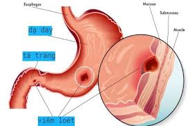Thuốc medrol chỉ định cho bệnh. Má»™t Sá»' Nhom Thuá»'c ThÆ°á»ng Ä'Æ°á»£c Sá»­ Dá»¥ng Trong Ä'iá»u Trá»‹ Viem Loet Dáº¡ Day Vinmec