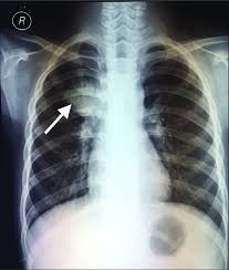Thus chest x rays are neither specific nor sensitive and so remain a supplement to microbiological tests such as microscopy pcr and culture. Chest X Ray Showed Signs Of Tuberculosis Lymphadenopathy On The Right Download Scientific Diagram